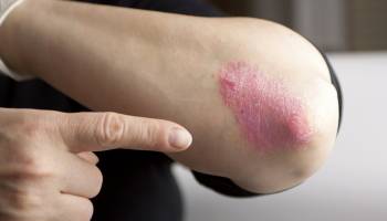 Psoriasis Risks Are More Than Skin-Deep 
