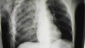 Sjögren’s Syndrome Can be Dangerous for Your Heart And Lungs