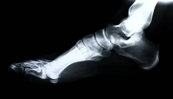 Kevin Durant's Pesky Foot
