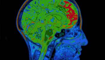 Diabetes and Alzheimer's: Another Possible Link
