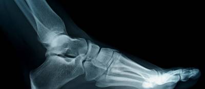 Don't Miss Out — Rx Can Strengthen Men's Bones