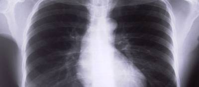 Guidelines Excluded Some from Lung Cancer Screening